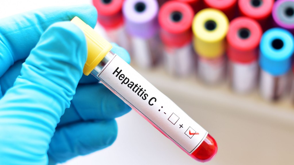 8 de cada 10 pacientes con hepatitis C no saben que la tienen