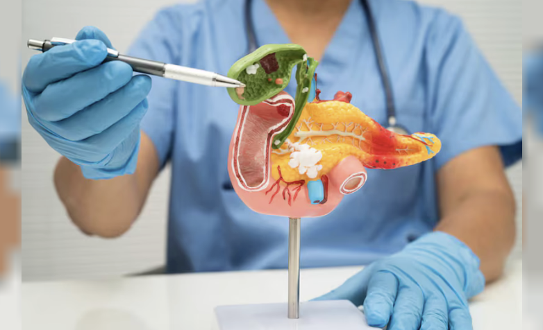 Avances contra el cáncer de páncreas: una terapia dirigida lograría duplicar la supervivencia